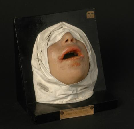 museo hospital san luis paris dermatologia enfermedades cutaneas lepra